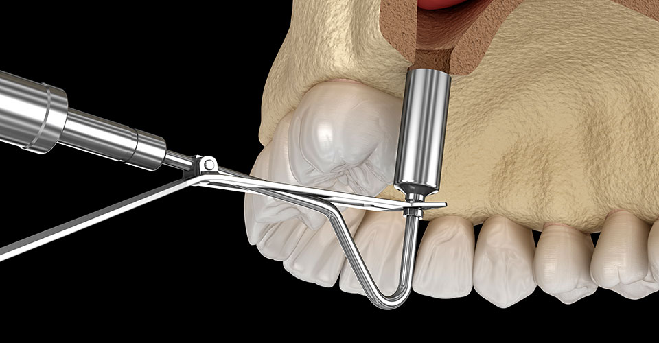 sinus-lifting2