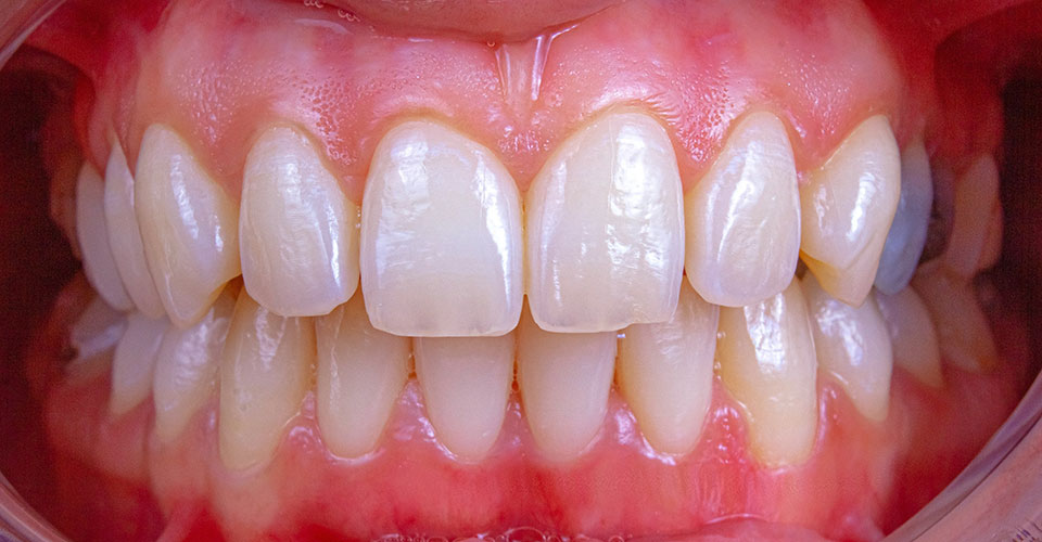 gingivitis2