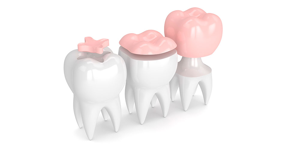 dental-restoration3